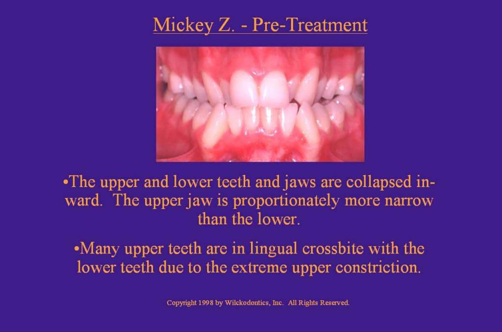 Wilkodontics slider image | Mickey Z | Pre Treatment 