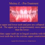 Wilkodontics slider image | Mickey Z | Pre Treatment 