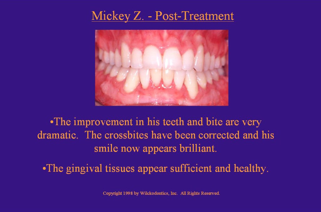 Wilkodontics slider image | Mickey Z | Post Treatment 