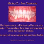 Wilkodontics slider image | Mickey Z | Post Treatment 