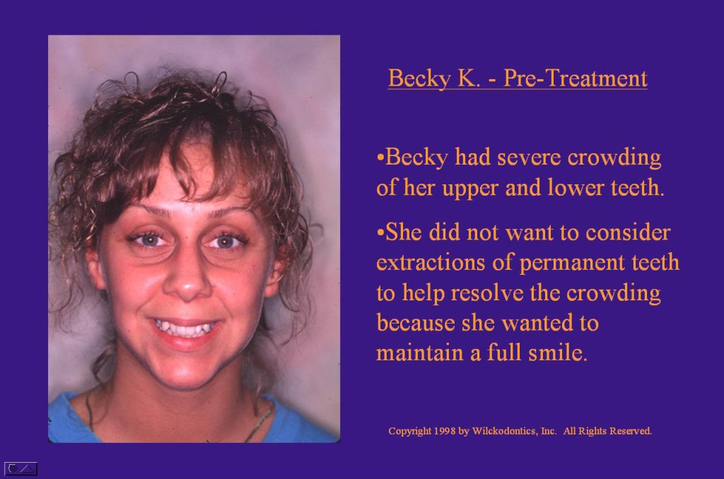 Wilkodontics slider image | Becky K | Pre Treatment 