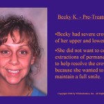 Wilkodontics slider image | Becky K | Pre Treatment 