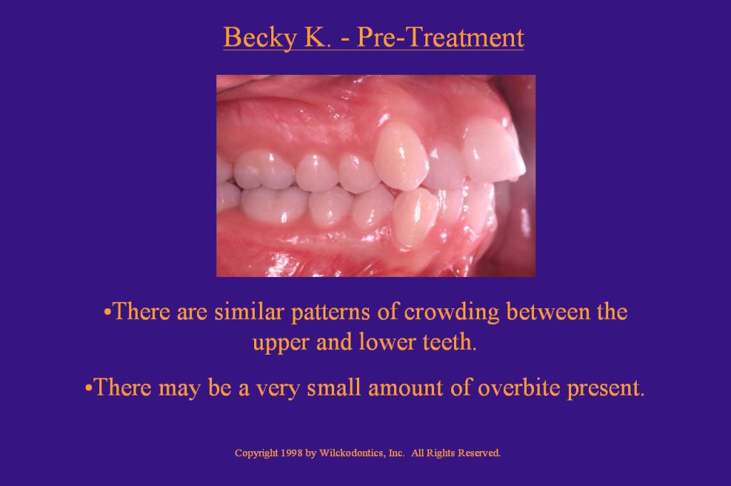 Wilkodontics slider image | Becky K | Pre Treatment 
