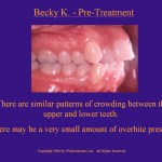 Wilkodontics slider image | Becky K | Pre Treatment 