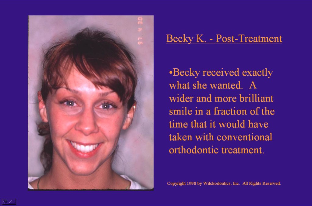 Wilkodontics slider image | Becky K | Post Treatment 