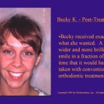 Wilkodontics slider image | Becky K | Post Treatment 