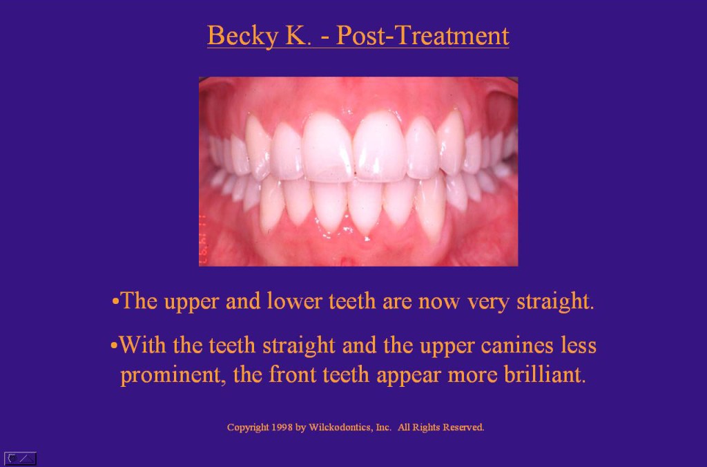 Wilkodontics slider image | Becky K | Post Treatment Case Study