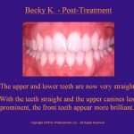 Wilkodontics slider image | Becky K | Post Treatment Case Study