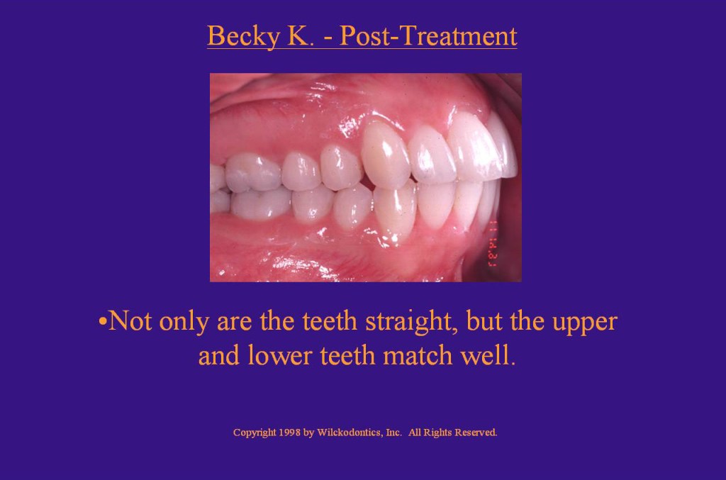 Wilkodontics slider image | Becky K | Post Treatment Case Study