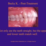 Wilkodontics slider image | Becky K | Post Treatment Case Study