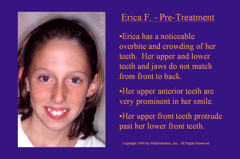 Wilkodontics slider image | Erica F | Pre Treatment 