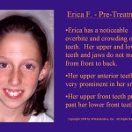 Wilkodontics slider image | Erica F | Pre Treatment 
