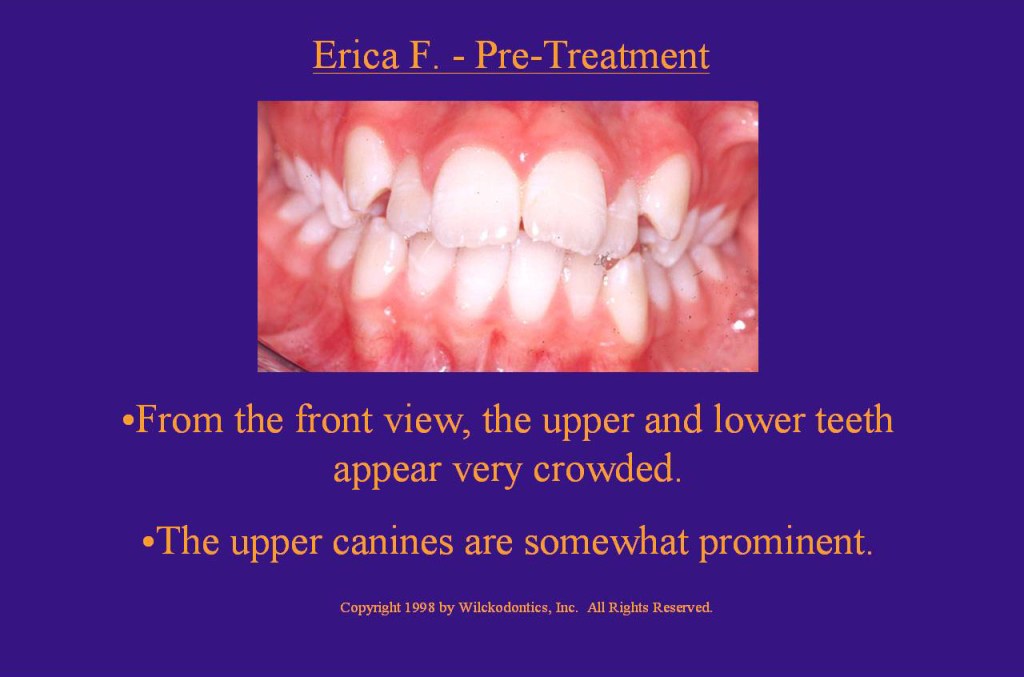 Wilkodontics slider image | Erica F | Pre Treatment  Case Study 