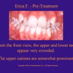 Wilkodontics slider image | Erica F | Pre Treatment  Case Study 