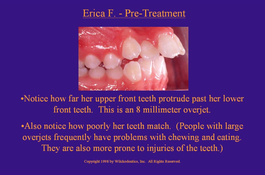 Wilkodontics slider image | Erica F | Pre Treatment  Case Study 