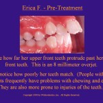 Wilkodontics slider image | Erica F | Pre Treatment  Case Study 