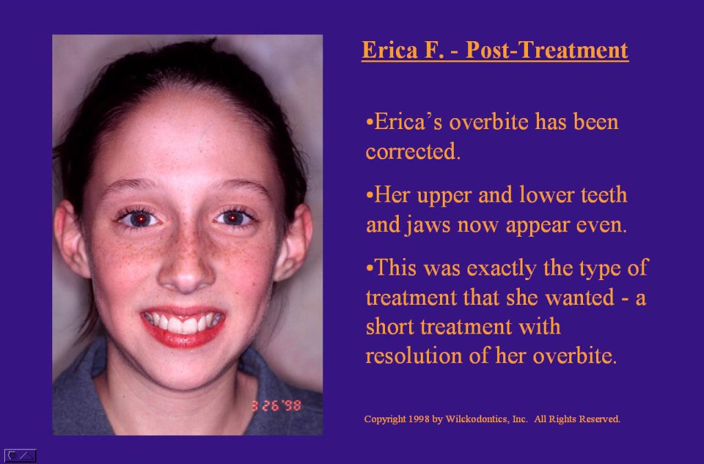 Wilkodontics slider image | Erica F | Post Treatment