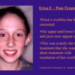 Wilkodontics slider image | Erica F | Post Treatment