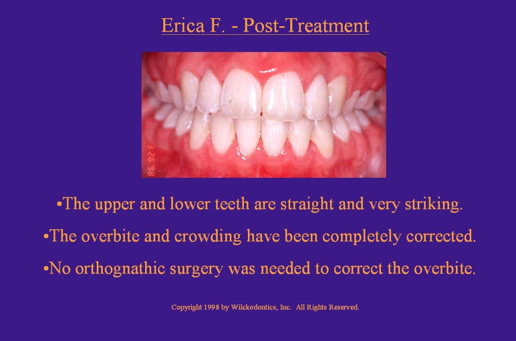 Wilkodontics slider image | Erica F | Post Treatment Case Study 