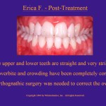 Wilkodontics slider image | Erica F | Post Treatment Case Study 