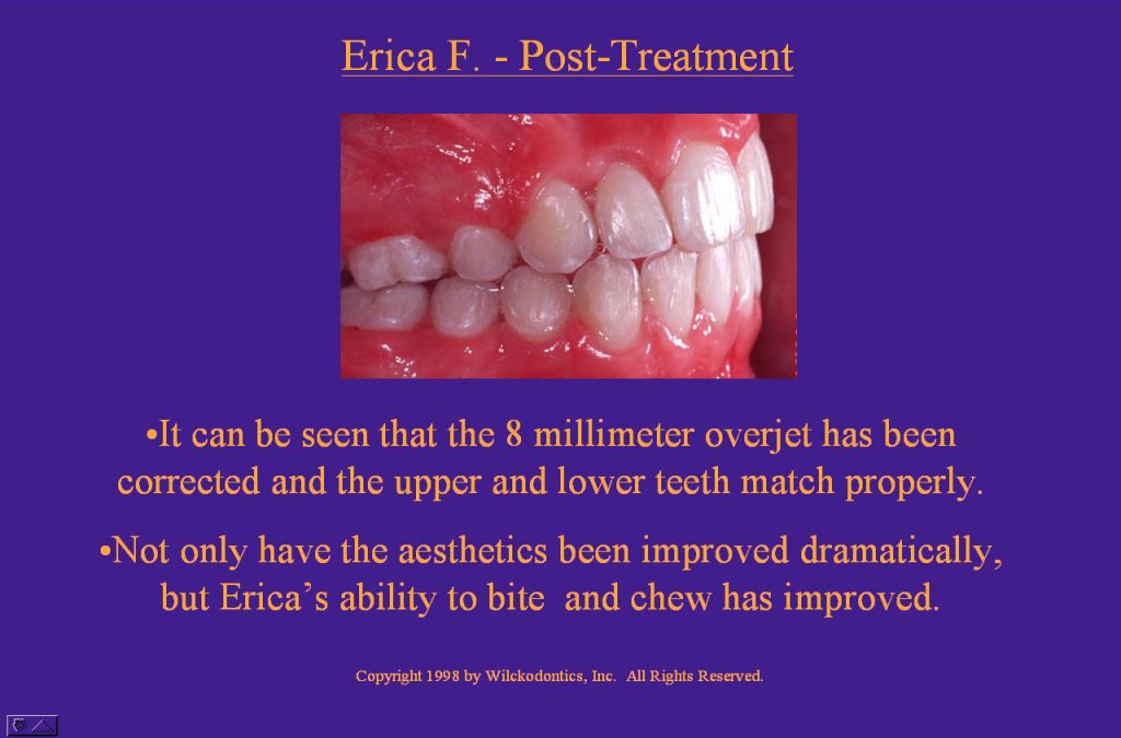 Wilkodontics slider image | Erica F | Post Treatment Case Study 