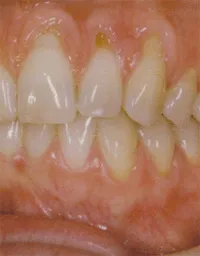 Case 1 before, teeth with missing gum tissue