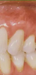 Case 1 after, teeth with restored gum tissue