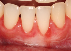 After Frenectomy & Gingival Graft