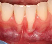 Before Frenectomy & Gingival Graft