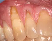 Before Connective Tissue Graft