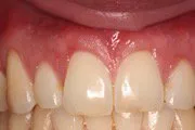 After Connective Tissue Graft