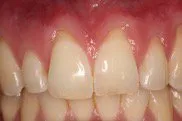 Before Connective Tissue Graft