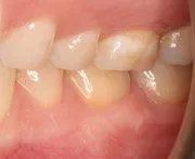 After Connective Tissue Graft