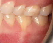 Before Connective Tissue Graft