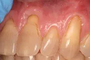 Before Connective Tissue Graft