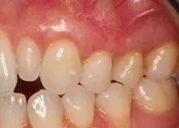 After Connective Tissue Graft