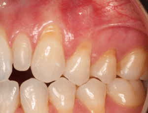 Before Connective Tissue Graft
