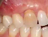 After Connective Tissue Graft