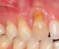 Before Connective Tissue Graft