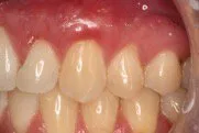 After Connective Tissue Graft