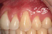 Before Connective Tissue Graft