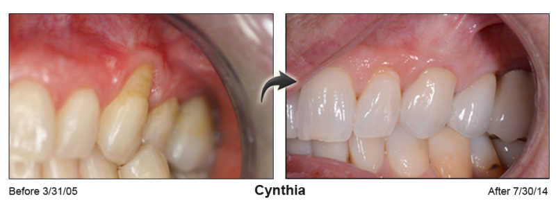 Pinhole Gum Rejuvenation™ Before & After