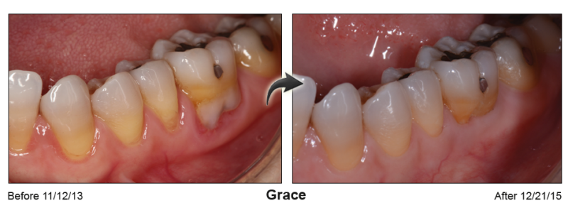 Pinhole Gum Rejuvenation™ Before & After