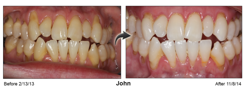 Pinhole Gum Rejuvenation™ Before & After