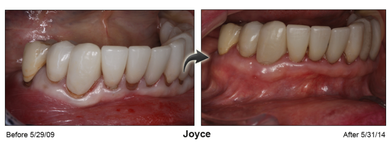 Pinhole Gum Rejuvenation™ Before & After