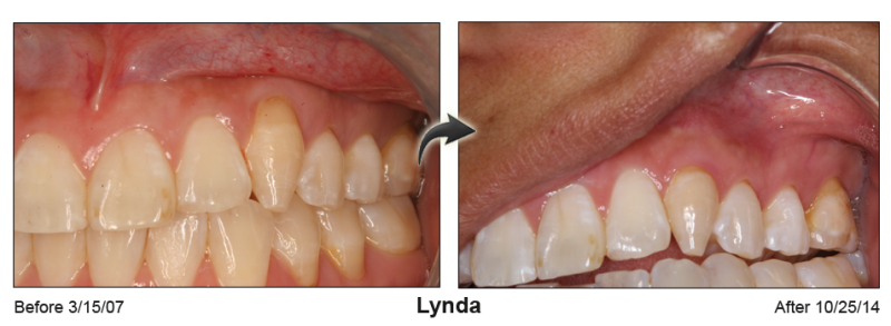 Pinhole Gum Rejuvenation™ Before & After