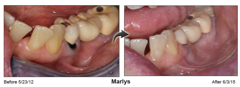 Pinhole Gum Rejuvenation™ Before & After