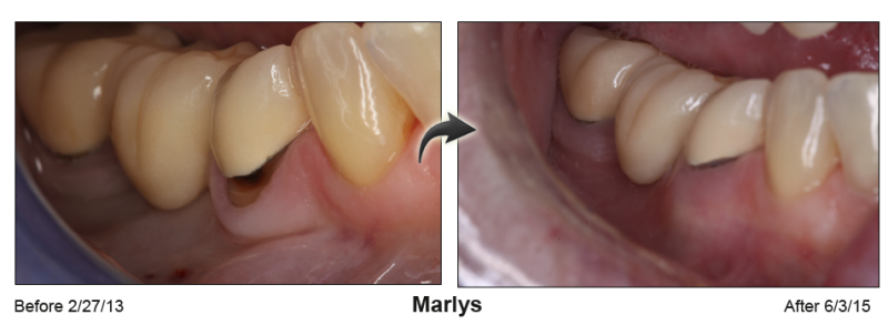 Pinhole Gum Rejuvenation™ Before & After