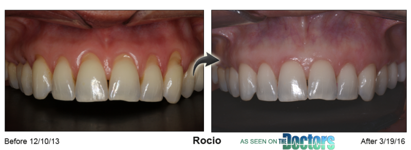 Pinhole Gum Rejuvenation™ Before & After