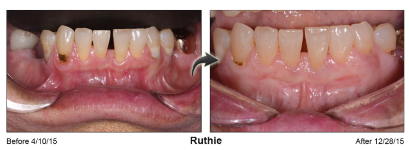 Pinhole Gum Rejuvenation™ Before & After